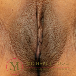 Labiaplasty Before & After Patient #4399