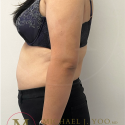 Arm Liposuction Before & After Patient #4397