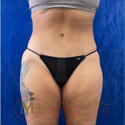 Tummy Tuck Before & After Patient #4380