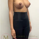 Breast Lift with Implants Before & After Patient #4368