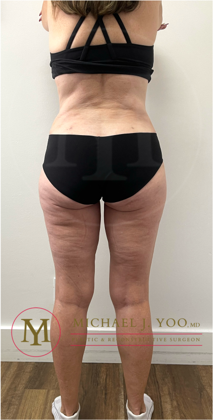 Tummy Tuck Before & After Patient #4444