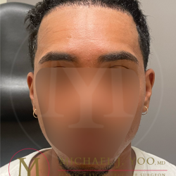 Forehead Reduction Before & After Patient #4436