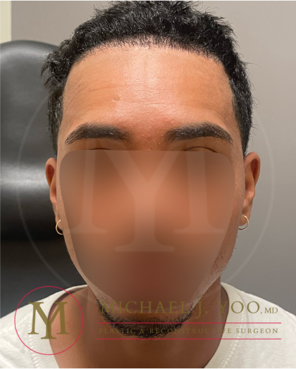 Forehead Reduction Before & After Patient #4436