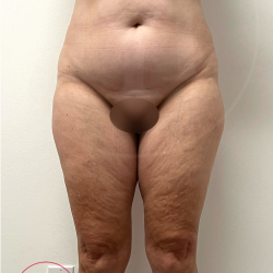 Tummy Tuck Before & After Patient #4444