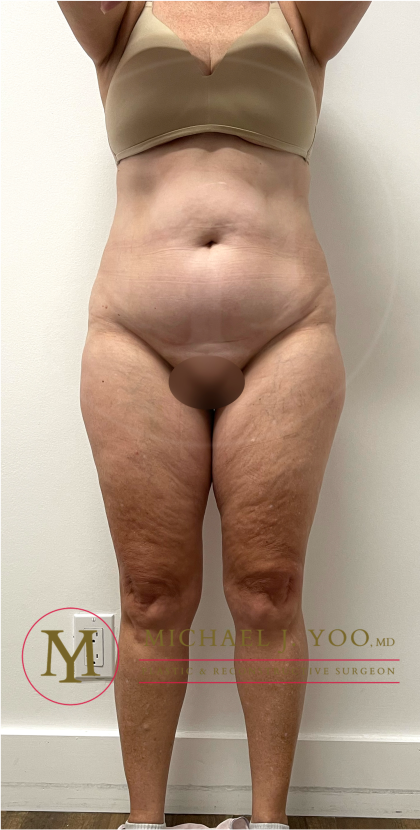 Tummy Tuck Before & After Patient #4444