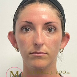 Otoplasty Before & After Patient #4437
