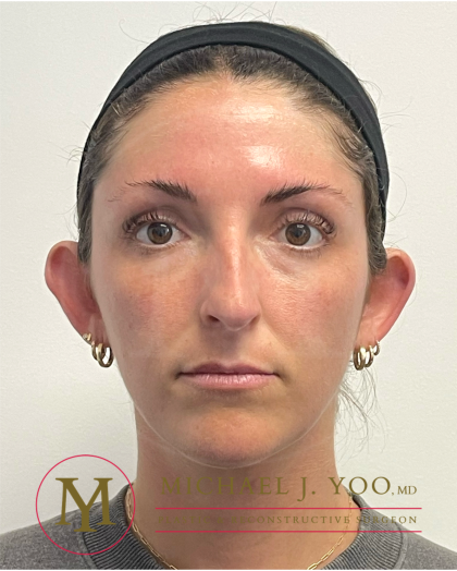 Otoplasty Before & After Patient #4437
