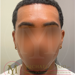 Forehead Reduction Before & After Patient #4436