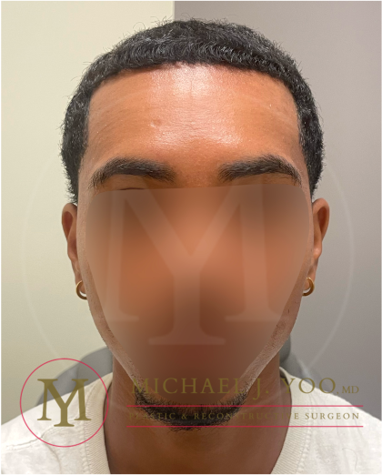 Forehead Reduction Before & After Patient #4436