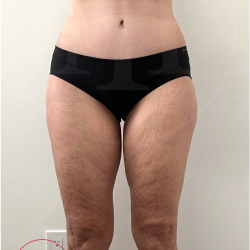 Tummy Tuck Before & After Patient #4444