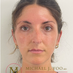 Otoplasty Before & After Patient #4437