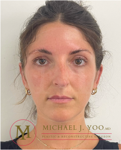 Otoplasty Before & After Patient #4437