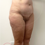 Tummy Tuck Before & After Patient #4444
