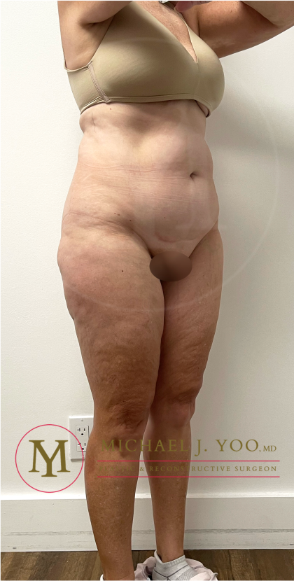 Tummy Tuck Before & After Patient #4444