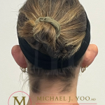Otoplasty Before & After Patient #4437