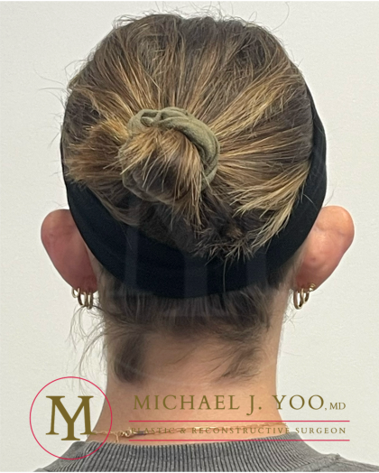 Otoplasty Before & After Patient #4437