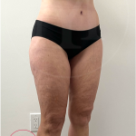 Tummy Tuck Before & After Patient #4444