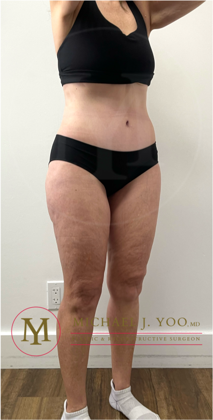 Tummy Tuck Before & After Patient #4444
