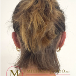 Otoplasty Before & After Patient #4437