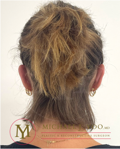 Otoplasty Before & After Patient #4437
