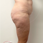 Tummy Tuck Before & After Patient #4444