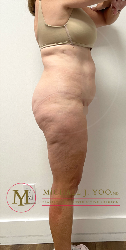 Tummy Tuck Before & After Patient #4444