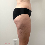Tummy Tuck Before & After Patient #4444
