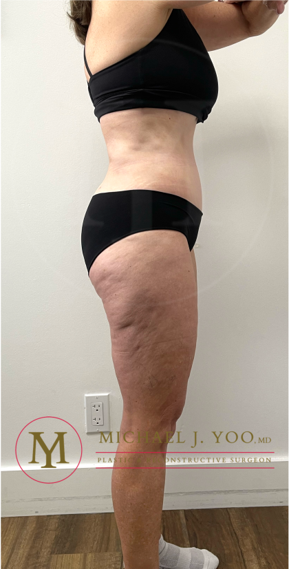 Tummy Tuck Before & After Patient #4444