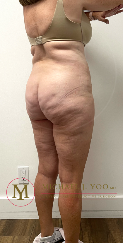 Tummy Tuck Before & After Patient #4444