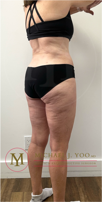 Tummy Tuck Before & After Patient #4444
