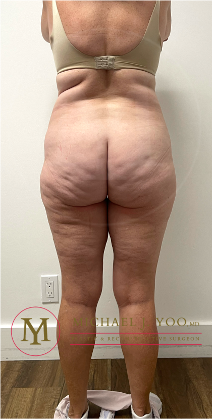 Tummy Tuck Before & After Patient #4444