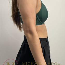 Arm Liposuction Before & After Patient #4463