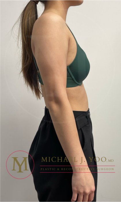 Arm Liposuction Before & After Patient #4463