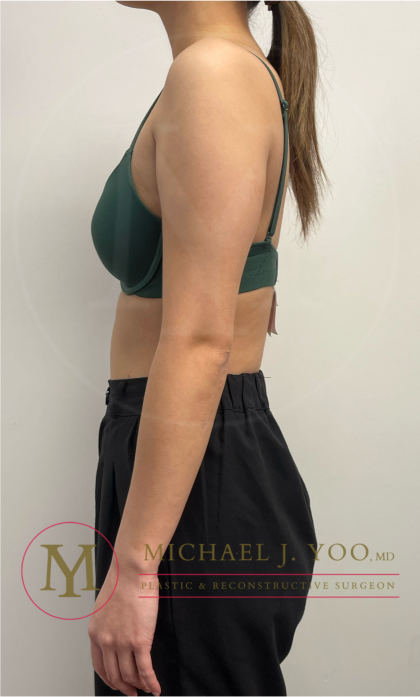 Arm Liposuction Before & After Patient #4463