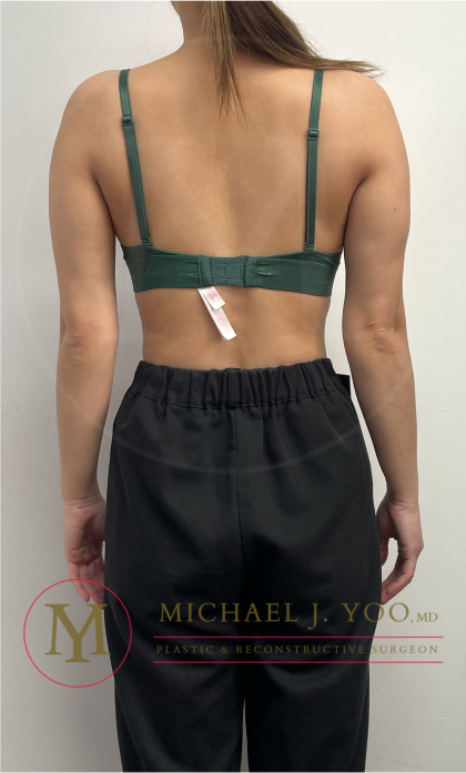 Arm Liposuction Before & After Patient #4463