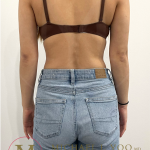Arm Liposuction Before & After Patient #4463