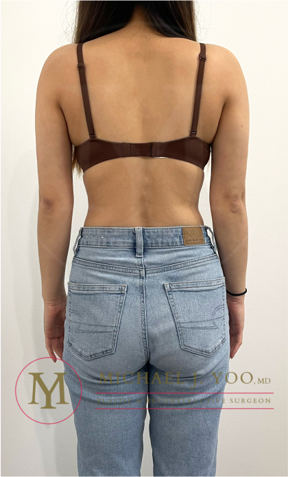Arm Liposuction Before & After Patient #4463