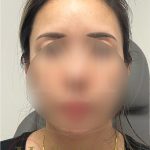 Forehead Reduction Before & After Patient #4491