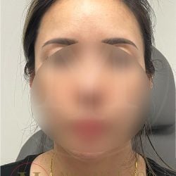Forehead Reduction Before & After Patient #4491