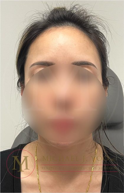 Forehead Reduction Before & After Patient #4491