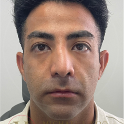 Facial Liposculpture Before & After Patient #4477