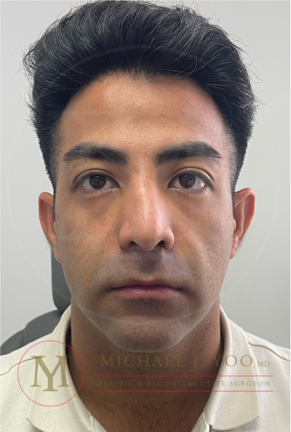 Facial Liposculpture Before & After Patient #4477