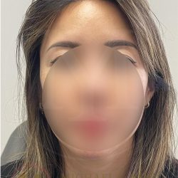 Forehead Reduction Before & After Patient #4491