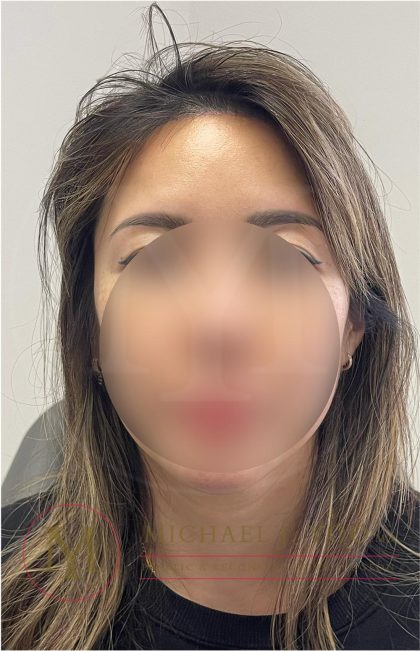 Forehead Reduction Before & After Patient #4491