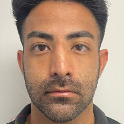 Facial Liposculpture Before & After Patient #4477