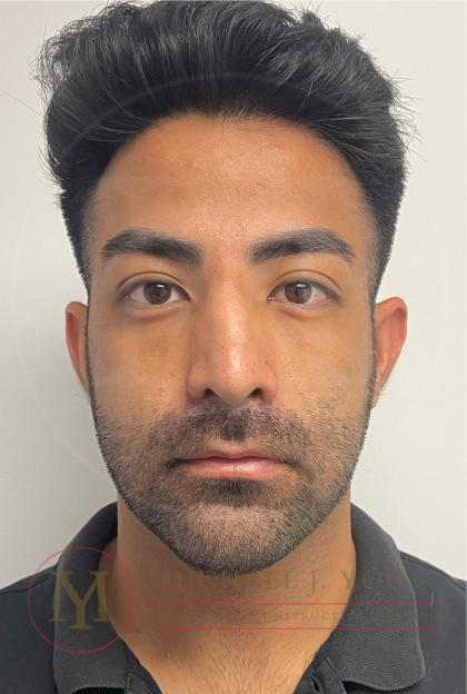 Facial Liposculpture Before & After Patient #4477