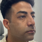 Facial Liposculpture Before & After Patient #4477