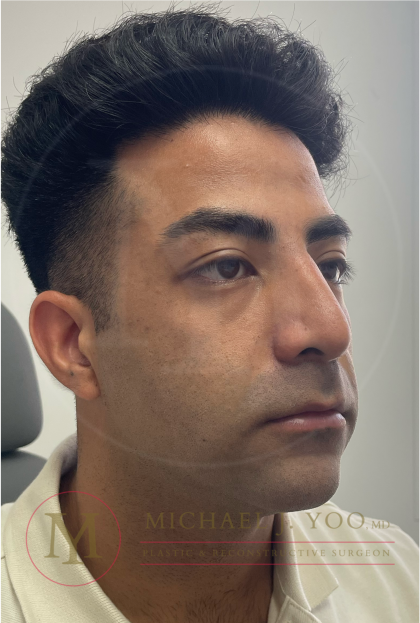 Facial Liposculpture Before & After Patient #4477