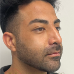 Facial Liposculpture Before & After Patient #4477