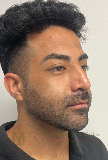 Facial Liposculpture Before & After Patient #4477